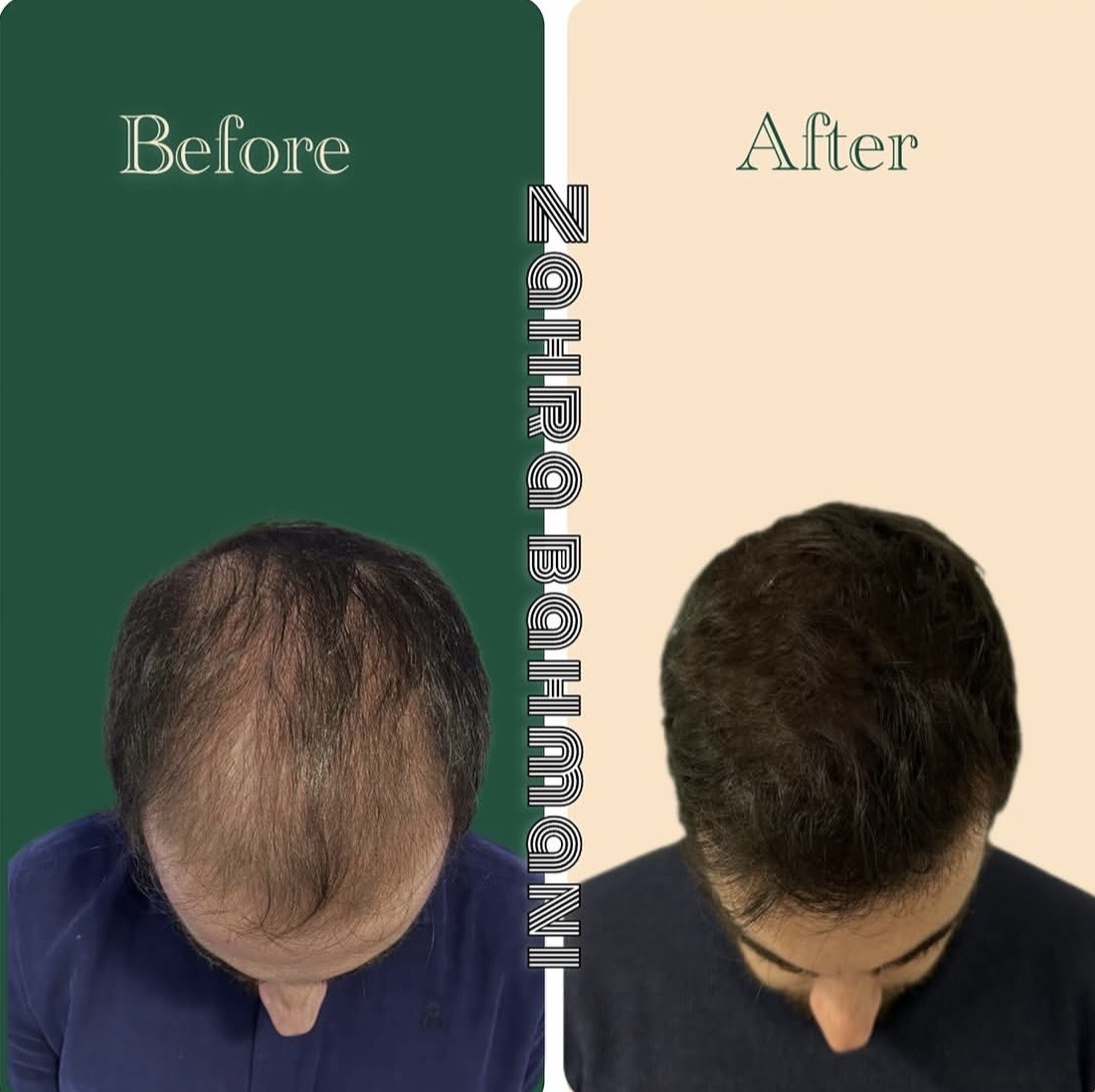 زراعة الشعر